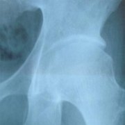 股骨头坏死早期X光片